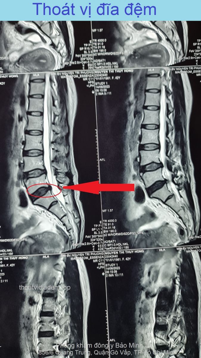 Thoát vị đĩa đệm